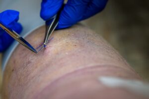 Como a Oxigenoterapia Hiperbárica Acelera a Cicatrização de Feridas?